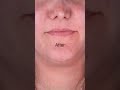MSE/MARPE face changes #mse #marpe #sarpe #tmj #tmd #airway #breathing