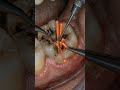 This Tooth Was ROTTING From Inside 😱