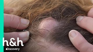 Tiene 6 Bultos En Su Cabeza Y 1 En Su Codo Dra. Sandra Lee Especialista En Piel Discovery H&H