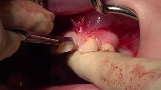 Augmentation of Severe Bone Atrophy in Patients with Oligodontia via Calvarial Bone