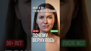 Акне в 30+ — почему вернулось и что делать. Кортизол, гормоны, нарушенный барьер.