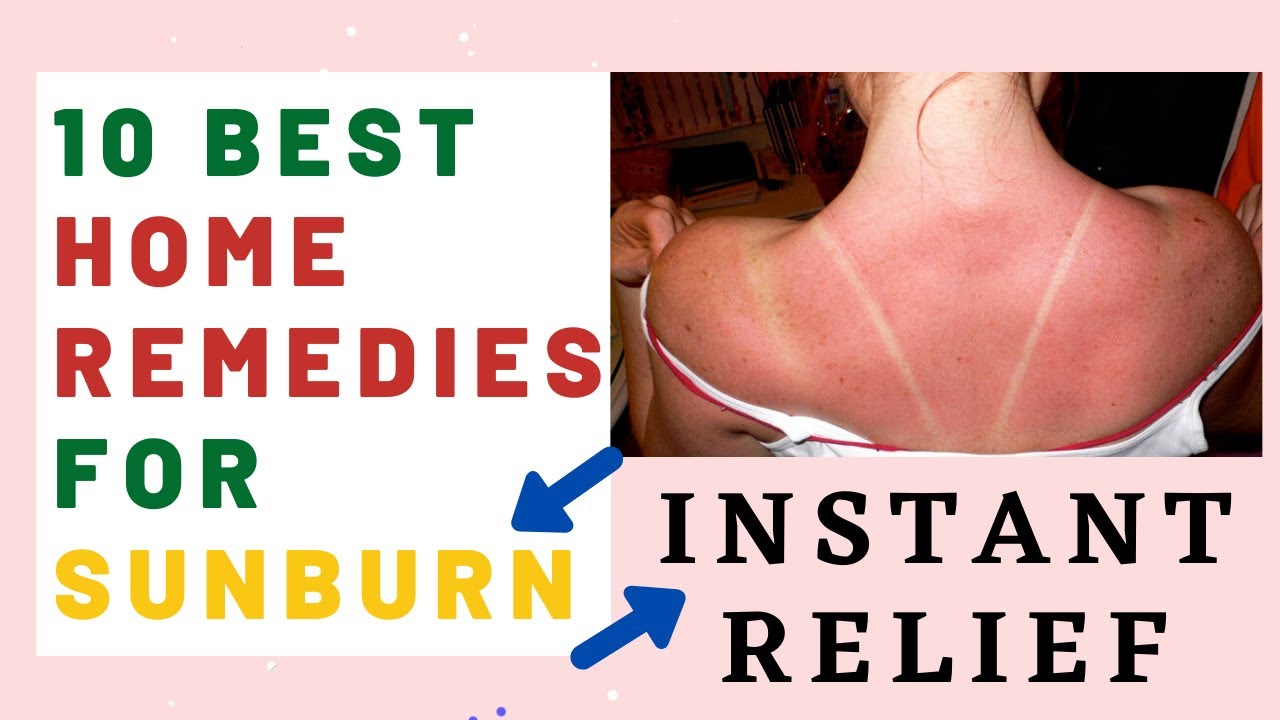 10 Best Home Remedy for Sunburn Sunburn Relief Sunburn Remedies