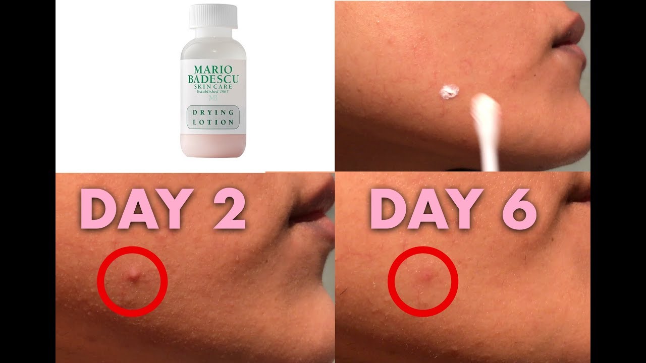TESTING MARIO BADESCU LOTION: How Many days get of a zit? - YouTube