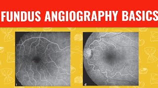 FFA course  || FUNDUS FLUORESCEIN ANGIOGRAPHY ||