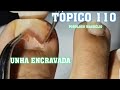 UNHA ENCRAVADA (ingrown toenail)( PODÓLOGO MAURÉLIO)