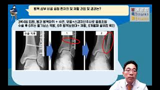 발톡 발목 상부 비골 골절의 수술사례