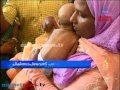 Infant birth injuries from obstetrical