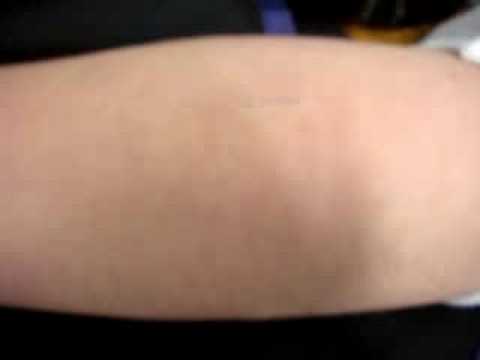 Dan gets a staple in his arm