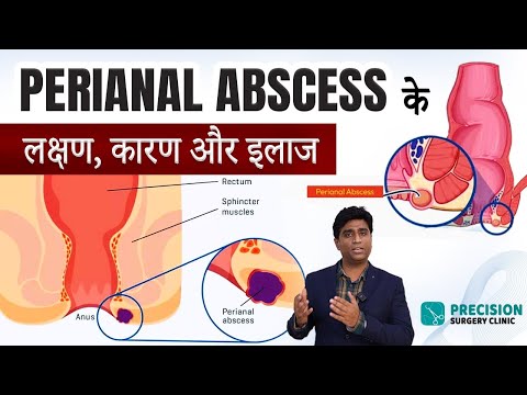 What is perianal abscess? Symptoms and treatment | Perianal abscess: Symptoms & Treatment Hindi |...