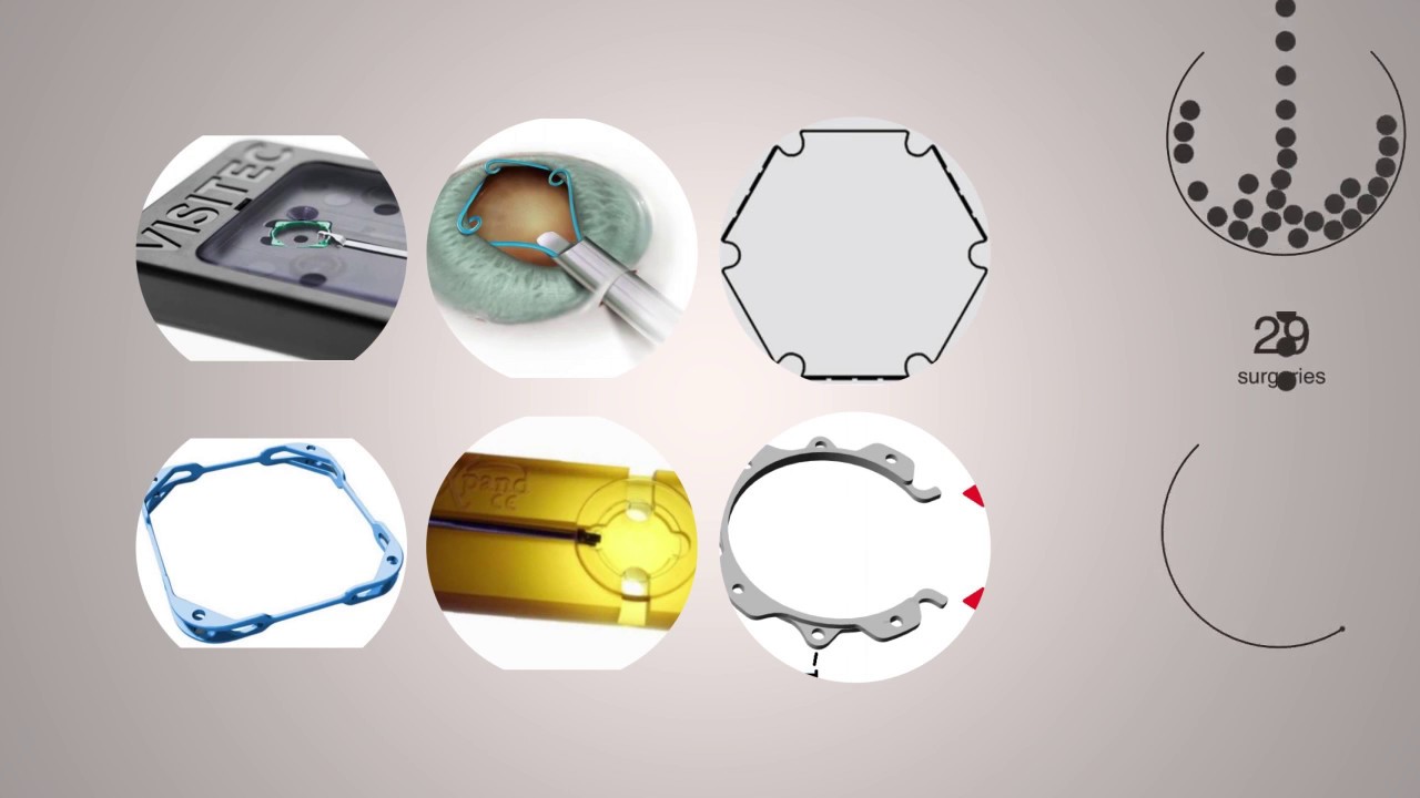 Pupil enlargement with the Malyugin ring. The leading scroll is... |  Download Scientific Diagram