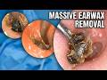 It Feels So Good When Earwax Is Removed 👂 | Relaxing Ear Wax Removal with Calm Music