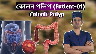 কলন পলপ Patient-01 Colonic Polyp Dr.sun