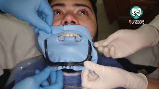 تركيب رابر دام على أسنان أمامية rubber dam  for antterior teeth  مع التعامل مع حواف الأسنان المتصدعة