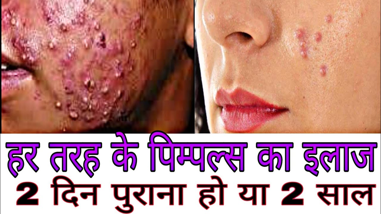 modicare pimple treatment