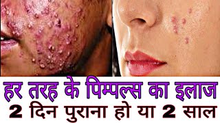 Pimples treatment with modicare products/ oily skin/ dry skin/ acne / jyoti rawat/ rishikesh