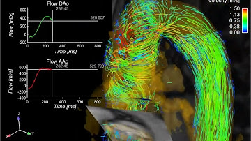 Aortic 4D flow MRI   3D blood flow in a patient with a bicuspid aortic valve osgSmEMGSyk