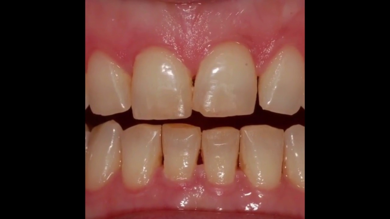 Pacific Dental Care Veneers by Dr. Martirosyan YouTube