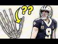 Doctor Reacts to Drew Brees Thumb Injury and Explains UCL Tears