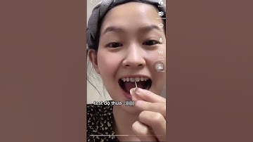 Tiết lộ hành trình niềng răng thưa?  #lamdep #niengrang #niengrangmaccai