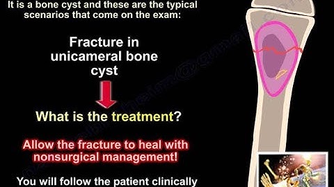 Bone Cyst ,Unicameral Bone Cyst - Everything You Need To Know - Dr. Nabil