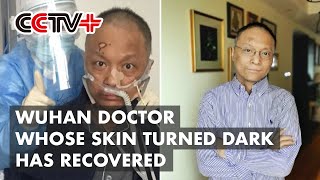 Wuhan Doctor Whose Skin Turned Dark Has Recovered