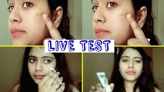 3 दिन मे चेहरे के दाने ठीक करे | Roop Mantra Zero Pimple Gel | LIVE TEST | BY SHRUTI MISHRA