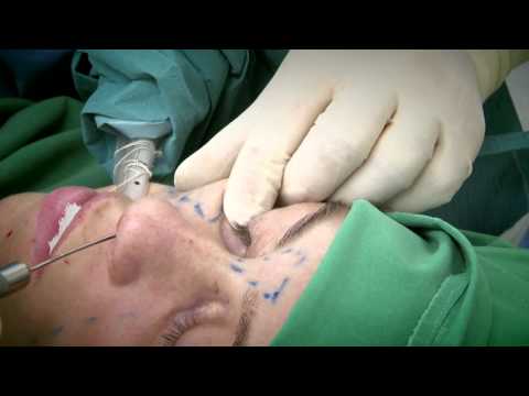 Video: Plastična Operacija: Najpoželjniji Nos