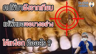 คนไข้อยากฝังรากเทียม แต่พี่หมอพบสิ่งผิดปกติ ใต้เหงือก มันอะไร ?!! | คลายปัญหารากเทียมกับหมอโชค