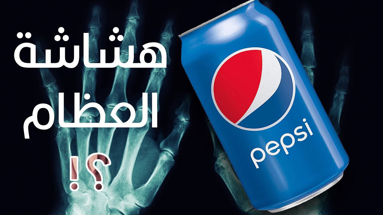 هل البيبسي بيسبب هشاشة العظام؟