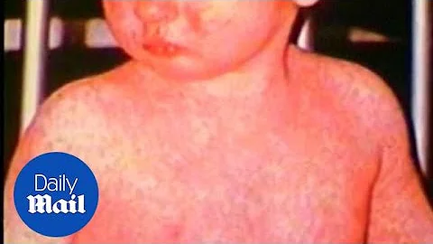 Measles outbreak hits record high since elimination in 2000