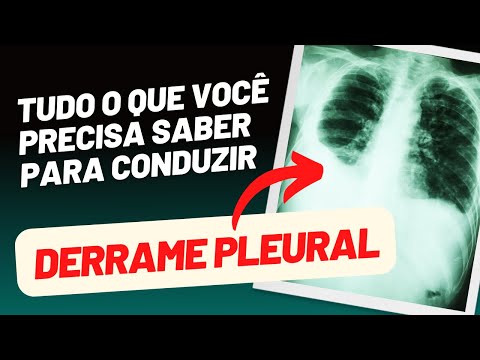 TUDO O QUE VOCÊ PRECISA SABER PARA CONDUZIR DERRAME PLEURAL