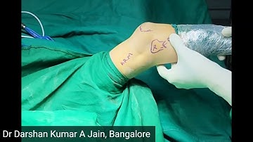 Pivot shift test for PLRI