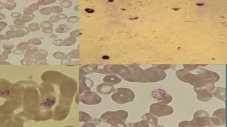Malarial parasite under microscope.Malarial microscopy. Plasmodium vivax.