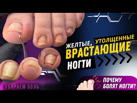 Желтые, утолщенные, врастающие ногти / Убираем боль / Почему болят ногти? #вросший #желтыйноготь