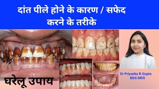 दांत पीले होने के कारण और उनके सभी समाधान। Clinic and Home Remedies for Yellow Teeth