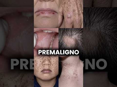 Lesiones premalignas y síndromes que predisponen al cáncer. #dermatologia #dermatologo #medicina