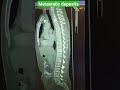 Metastatic deposits at liver ,spine ,chest ,adrenal gland. #mri #ct  #viralvideo #viral  #shorts