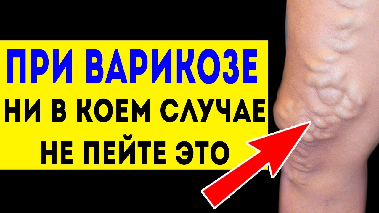 Бутакова варикозное расширение вен видео thumbnail