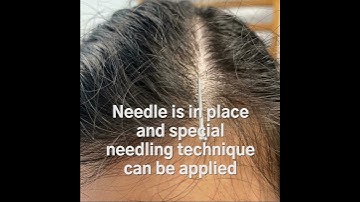 Scalp Acupuncture Technique