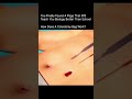 How Does A Colostomy And Ileostomy Bag Work?? #shorts #ostomy #ileostomy #colostomy #stoma #fyp