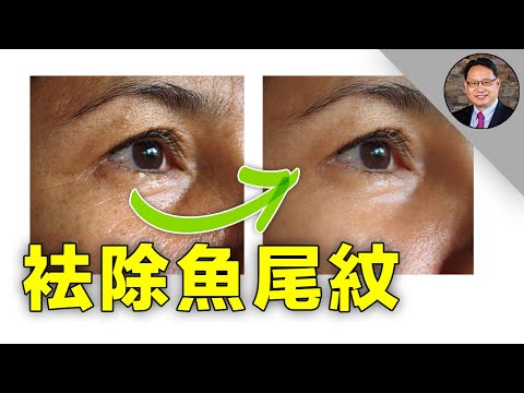 怎样用自然方法消除鱼尾纹？