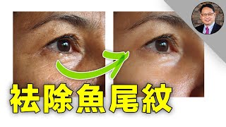 怎樣用自然方法消除魚尾紋？