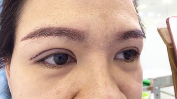 Cận cảnh cắt mí Mani Open Deep cho vị khách hàng