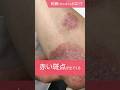 乾癬(かんせん)とはどんな病気!?#千里中央花ふさ皮ふ科 #乾癬 #shorts