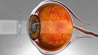 Dr McCauley 02 - What are Cataracts?