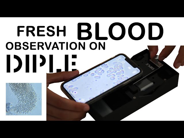 Fresh blood observation on DIPLE