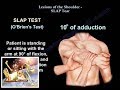 Lesions Of The Shoulder SLAP Tear - Everything You Need To Know - Dr. Nabil Ebraheim