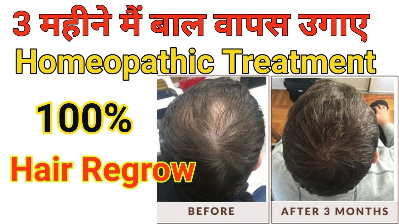 Hair Regrowth Homeopathic Treatment YouTube