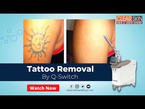 Laser Tattoo Removal Treatment in Kurnool, Hyderabad, Bangalore and India