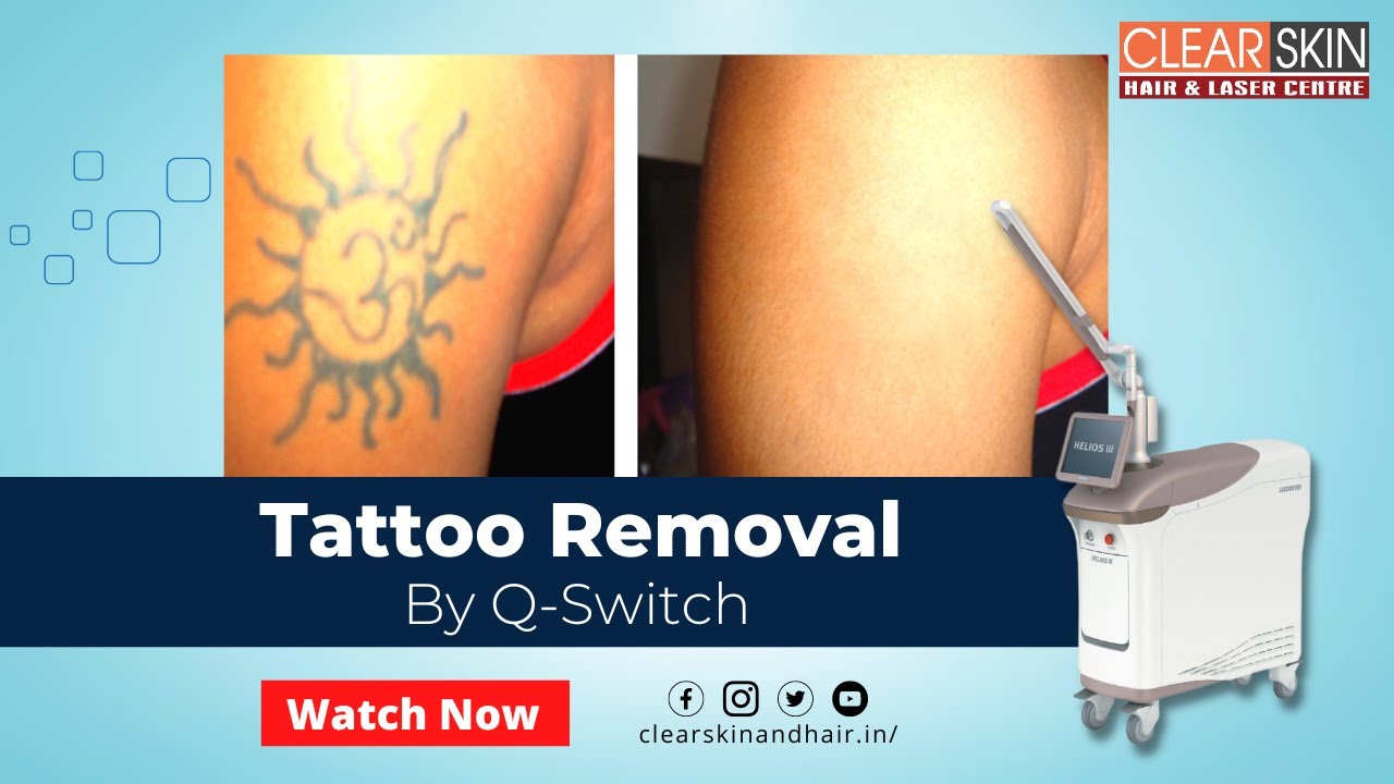 laser tattoo removal work with ND YAG Best skin specialist in Kurnool